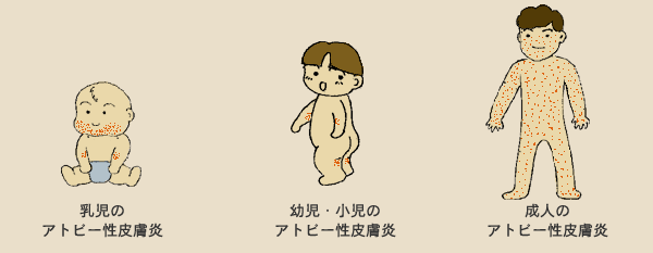 乳児のアトピー性皮膚炎／幼児・小児のアトピー性皮膚炎／成人のアトピー性皮膚炎